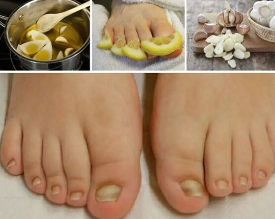 Beliebte Heilmittel gegen Nagelpilze