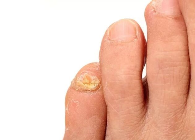 Nagelpilz