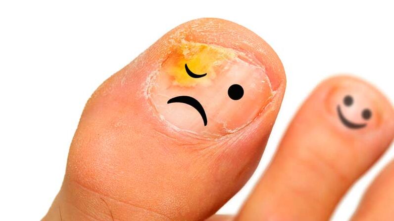 Nagelpilz