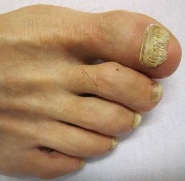 Nagelschilde beschädigt