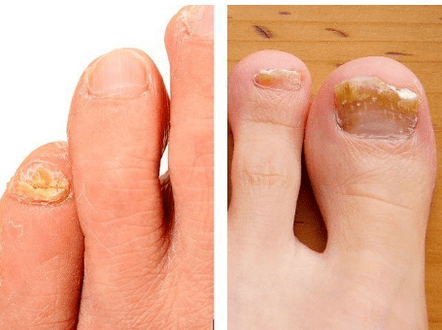 Nagelpilz