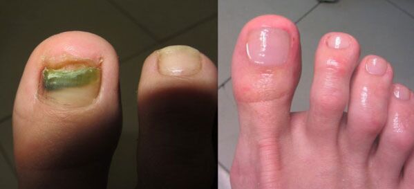 Nagelpilzbehandlung