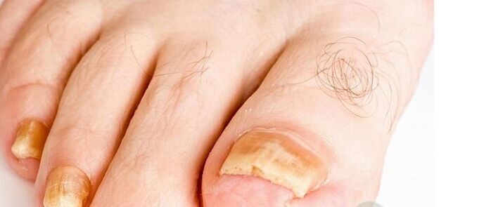 Fingernagelpilzsorten